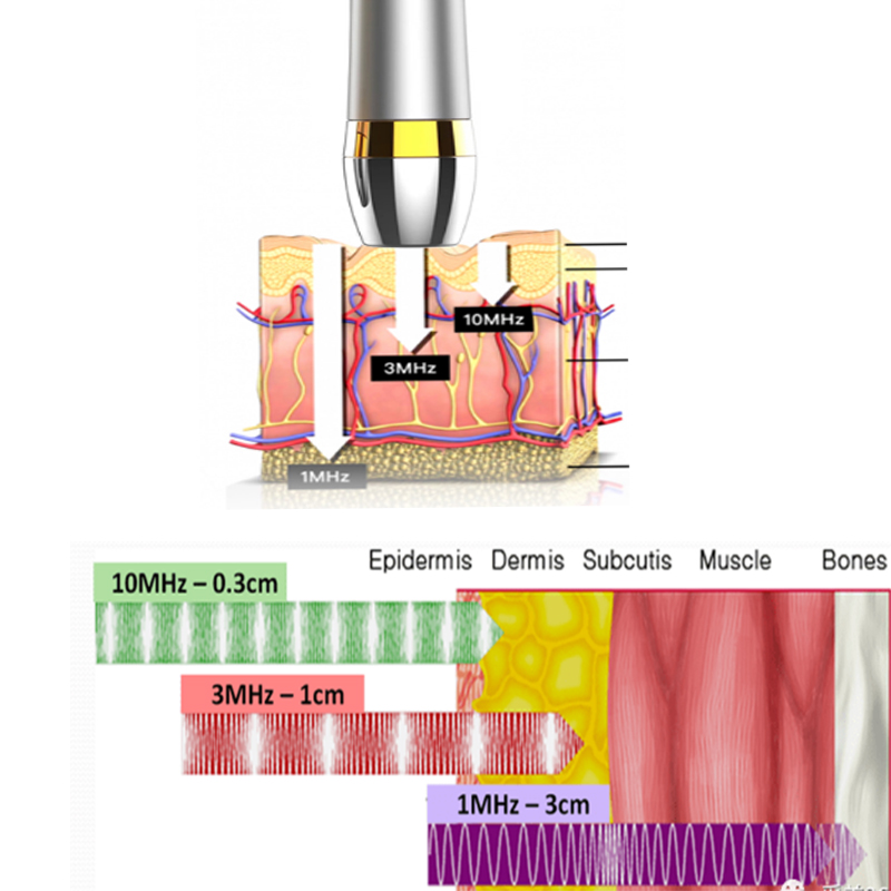 The10MHz Ultrasonic Beauty Instrument utvecklat av företaget